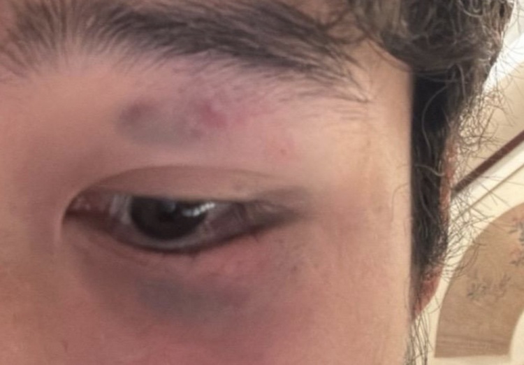 阮奇龍報(bào)平安 頭部遭任意球重?fù)艉蟪霈F(xiàn)頭暈嘔吐癥狀 阮奇龍報(bào)平安 頭部遭任意球重?fù)艉蟪霈F(xiàn)頭暈嘔吐癥狀